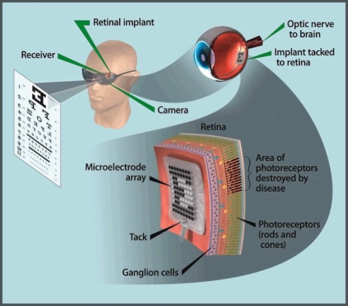 视网膜植入物工作原理的高级图表。